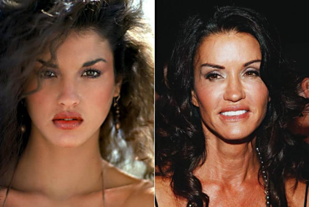 20-worst-cases-of-celebrity-plastic-surgery-gone-wrong-14.jpg
