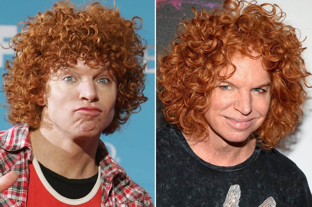20-worst-cases-of-celebrity-plastic-surgery-gone-wrong-15.jpg