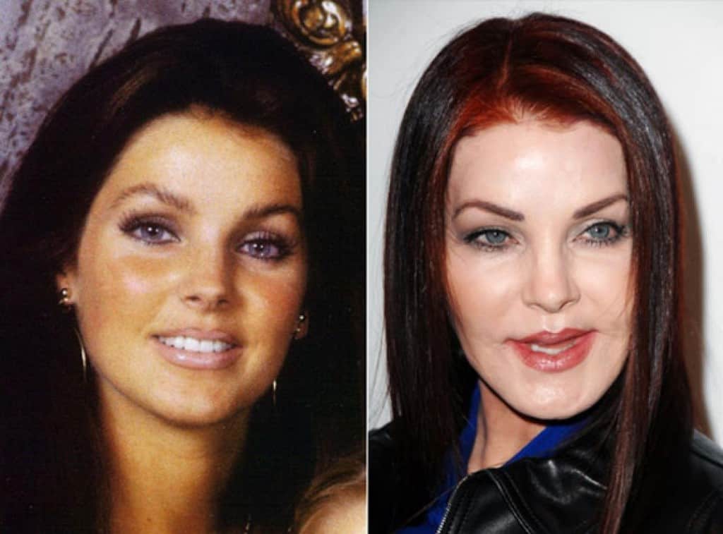 20-worst-cases-of-celebrity-plastic-surgery-gone-wrong-18.jpg