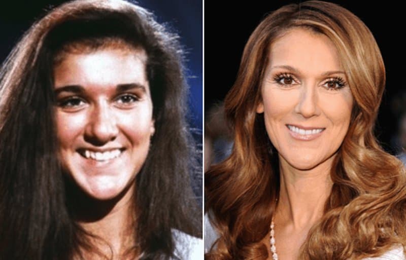 20-celebrities-who-have-undergone-plastic-surgery-1.jpg