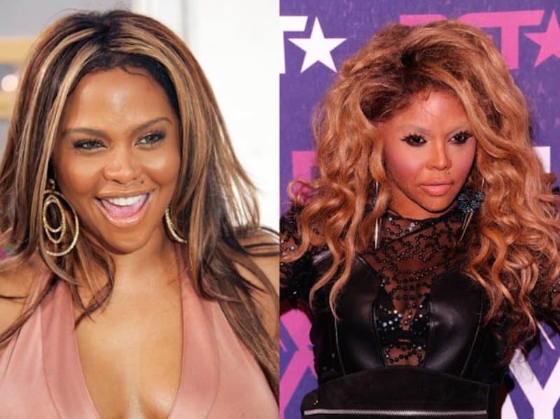 20-celebrities-who-have-undergone-plastic-surgery-16.jpg