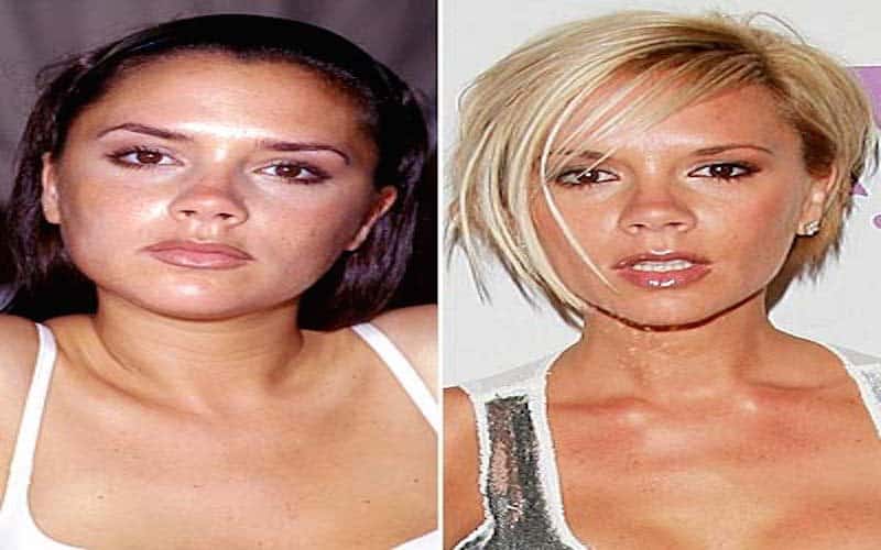 20-celebrities-who-have-undergone-plastic-surgery-19.jpg