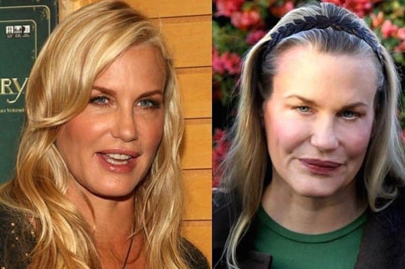 20-celebrities-who-have-undergone-plastic-surgery-3.jpg