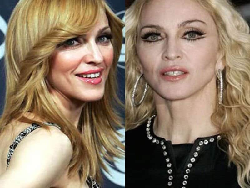 20-celebrities-who-have-undergone-plastic-surgery-5.jpg