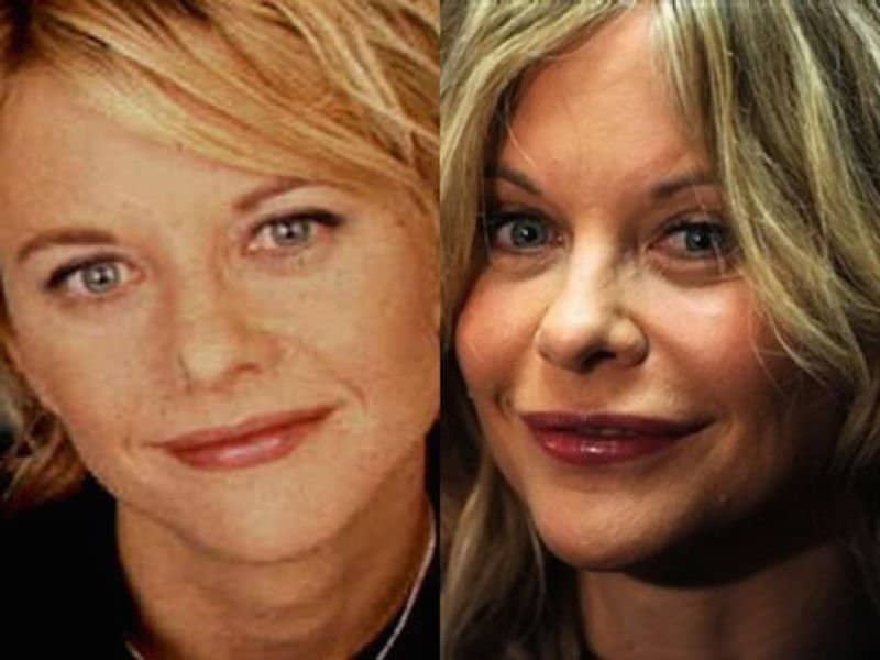 20-celebrities-who-have-undergone-plastic-surgery-6.jpg