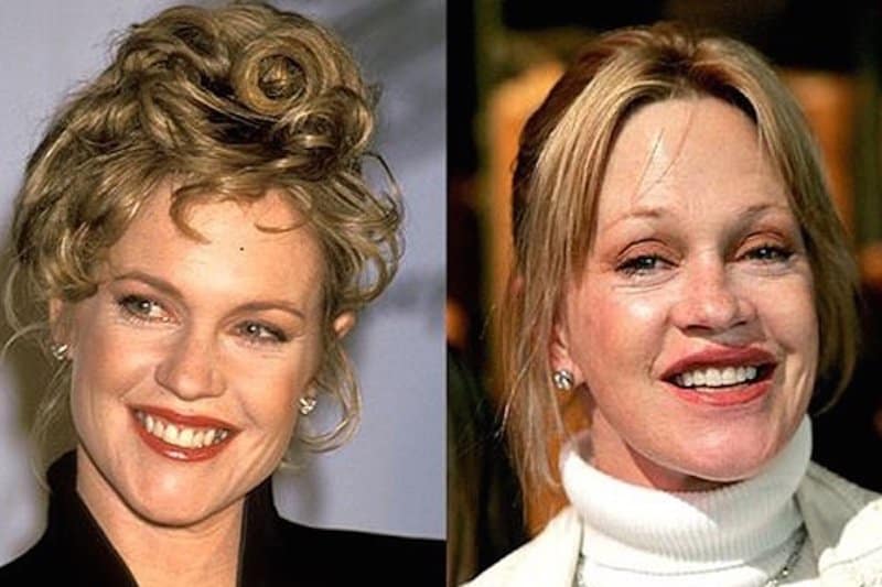 20-celebrities-who-have-undergone-plastic-surgery-7.jpg