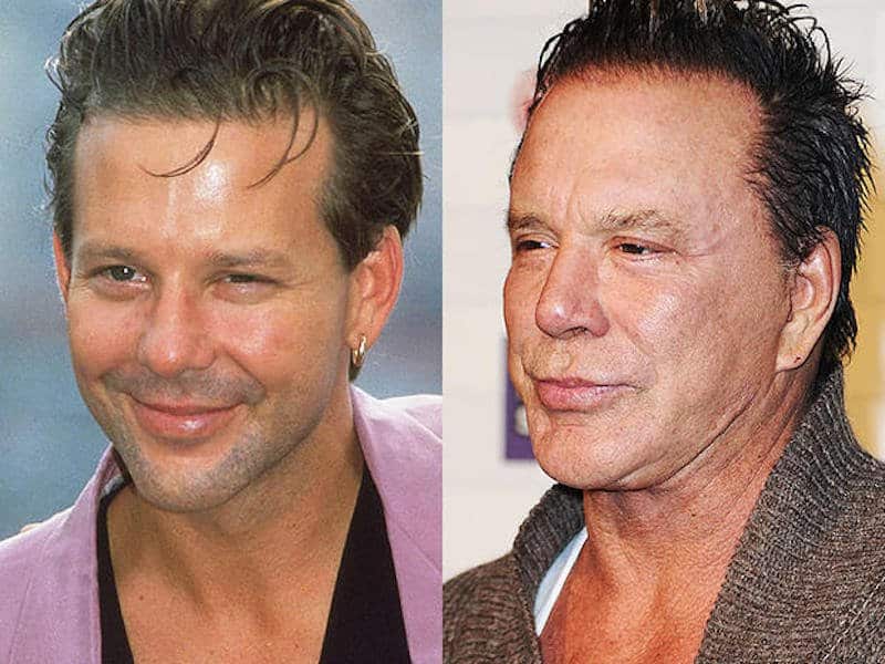 20-celebrities-who-have-undergone-plastic-surgery-12.jpg