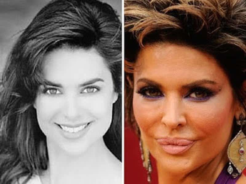 20-celebrities-who-have-undergone-plastic-surgery-14.jpg